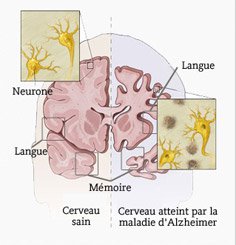 cerveau alzeimer