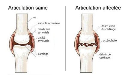 articulation arthrose