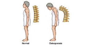 osteoporose